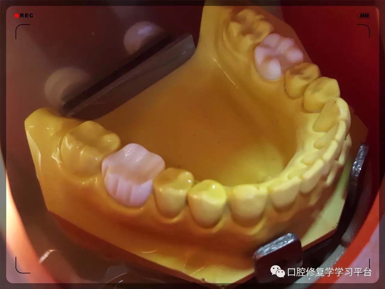 磨牙铸造金属全冠的牙体预备2.0(学生版)