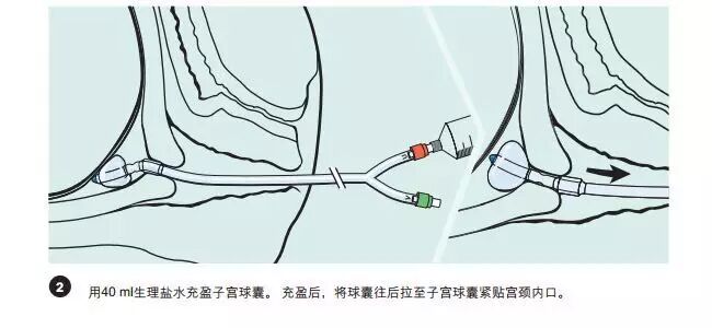 球囊怎么取出来分娩那些事之“COOK球囊引产”_https://www.jmylbn.com_新闻资讯_第3张