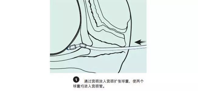 球囊怎么取出来分娩那些事之“COOK球囊引产”_https://www.jmylbn.com_新闻资讯_第2张