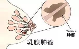 女性乳房有硬块意味着什么