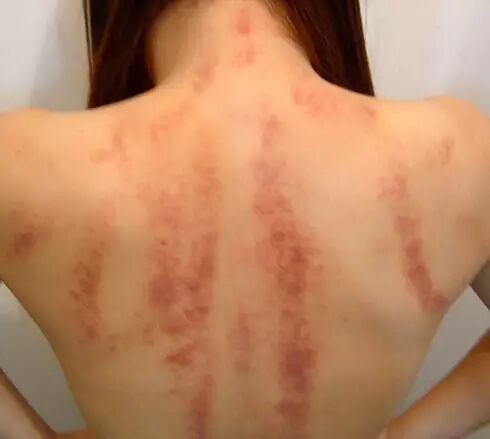 刮出来的痧和淤血是一回事吗？