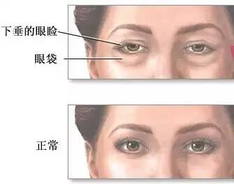 眼部的常见问题及护理方法！
