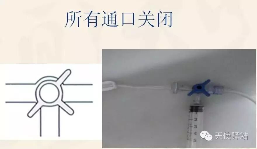 易造成交叉感染,而医用三通管为一次性灭菌物品,避免了交叉感染