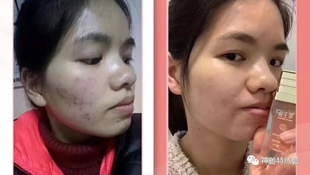 神首集团小兽的公主家护肤品真的有 美白淡斑 改善暗黄 修复红血丝敏感肌 改善痘痘肌肤和祛痘印和补水的功效吗 神兽特练营