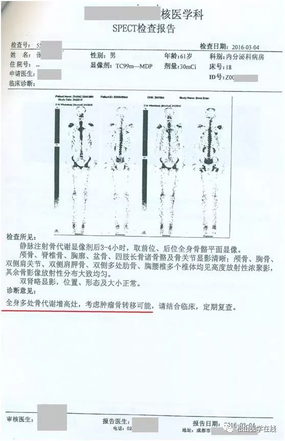 骨扫描:多处骨代谢增高考虑肿瘤转移可能,怀疑"血液系统恶性肿瘤.