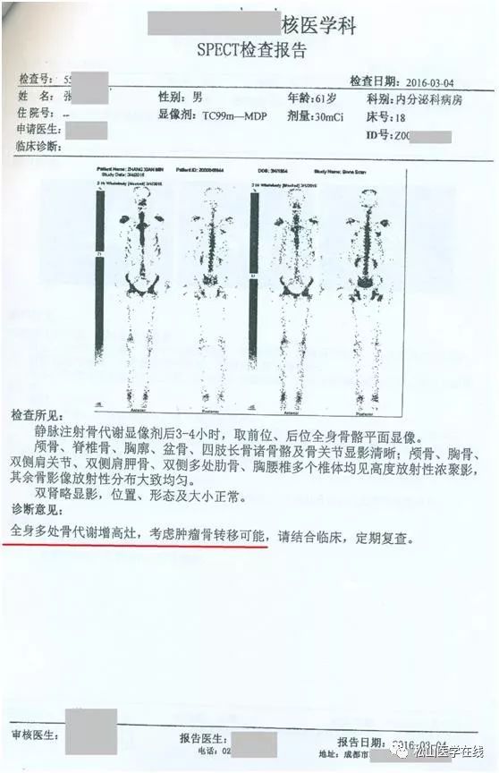 骨扫描:多处骨代谢增高考虑肿瘤转移可能,怀疑"血液系统恶性肿瘤".