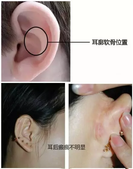 整形手術(shù)切口都藏在哪里？