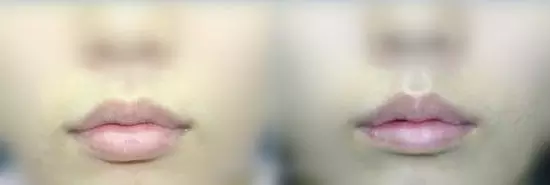 整形手術(shù)切口都藏在哪里？