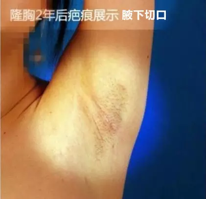 整形手術(shù)切口都藏在哪里？