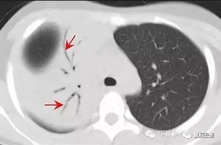 典型影像征象收集