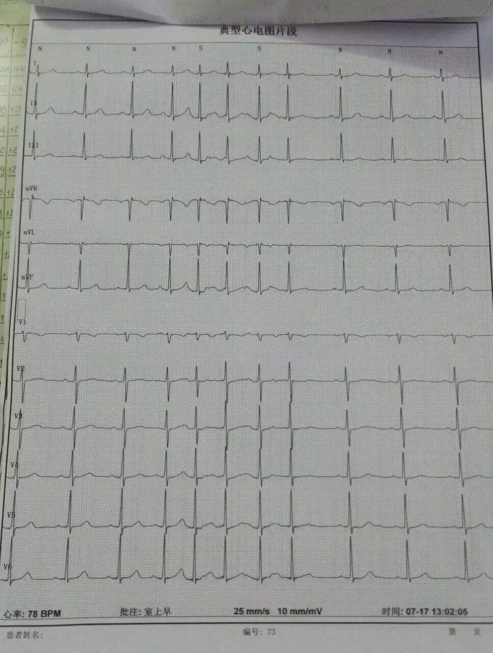 动态心电图接头怎么接【介绍】动态心电图_https://www.jmylbn.com_新闻资讯_第8张