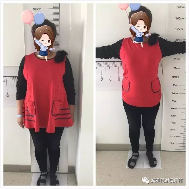 减重代谢手术成功案例