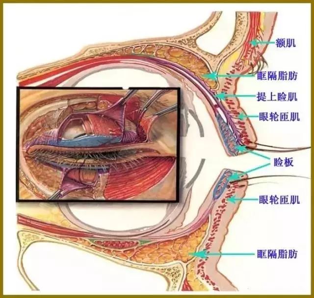 上睑下垂矫正术的操作步骤