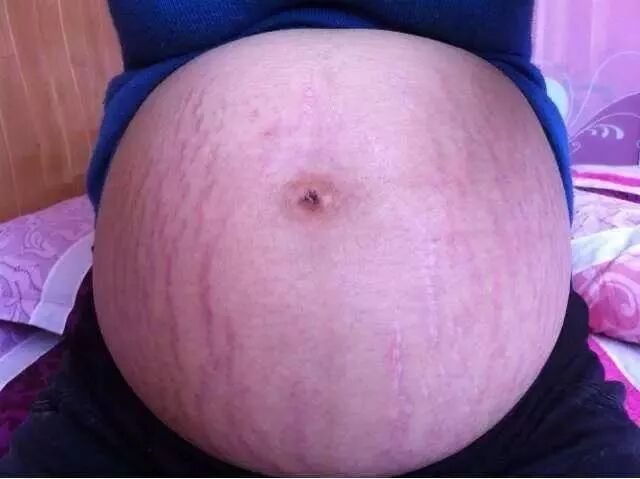 怀孕不想成为花肚皮,怎么办?-怀孕期