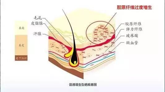 怀孕不想成为花肚皮,怎么办?-怀孕期