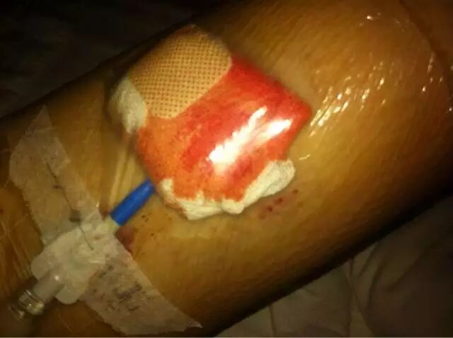 液体伤口敷料怎么用何时用？怎么用？——水胶体敷料在临床伤口处理中的应用前景_https://www.jmylbn.com_新闻资讯_第5张