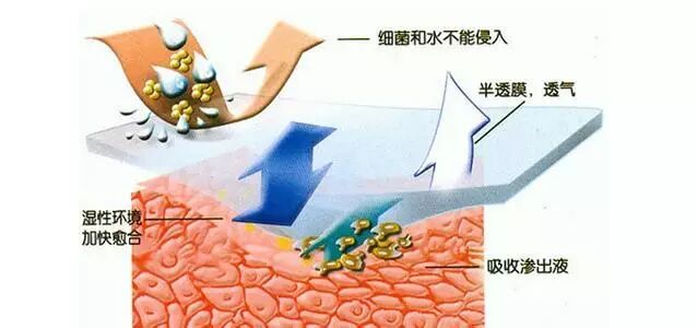 液体伤口敷料怎么用何时用？怎么用？——水胶体敷料在临床伤口处理中的应用前景_https://www.jmylbn.com_新闻资讯_第6张