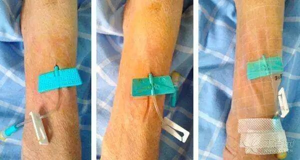 液体伤口敷料怎么用何时用？怎么用？——水胶体敷料在临床伤口处理中的应用前景_https://www.jmylbn.com_新闻资讯_第9张