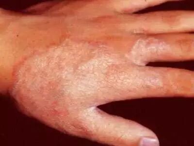 液体伤口敷料怎么用何时用？怎么用？——水胶体敷料在临床伤口处理中的应用前景_https://www.jmylbn.com_新闻资讯_第8张