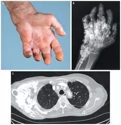 液体伤口敷料怎么用何时用？怎么用？——水胶体敷料在临床伤口处理中的应用前景_https://www.jmylbn.com_新闻资讯_第7张