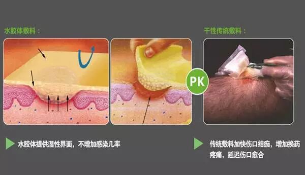 液体伤口敷料怎么用何时用？怎么用？——水胶体敷料在临床伤口处理中的应用前景_https://www.jmylbn.com_新闻资讯_第3张