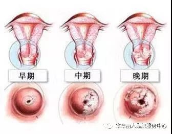 宫颈炎典型症状--白带异常看书v典型的美女图片图片