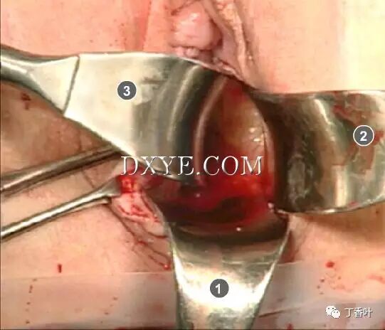 s拉钩怎么用RICHTER