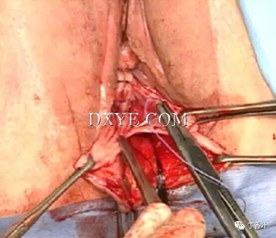 s拉钩怎么用RICHTER