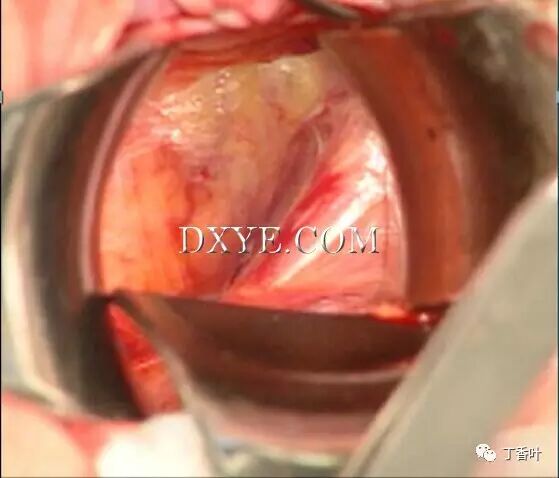 s拉钩怎么用RICHTER