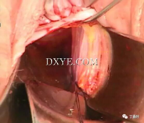 s拉钩怎么用RICHTER