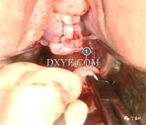 s拉钩怎么用RICHTER