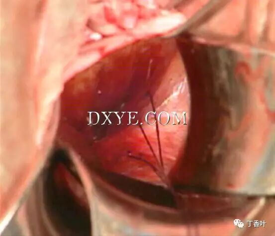 s拉钩怎么用RICHTER