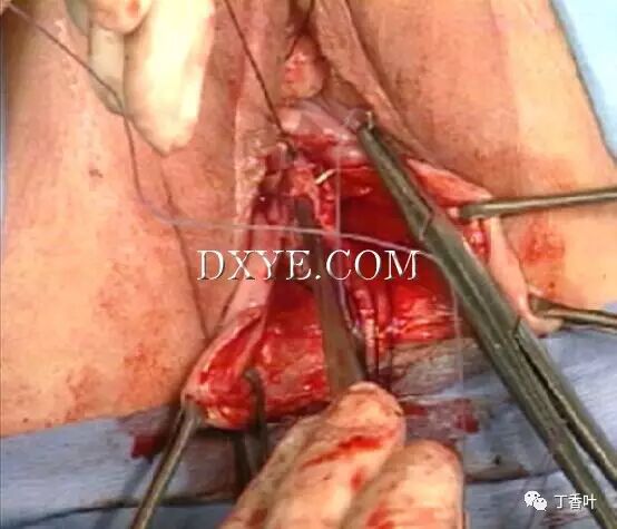 s拉钩怎么用RICHTER