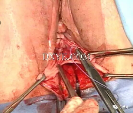 s拉钩怎么用RICHTER