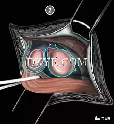 疝气补片怎么固定双层补片修补腹股沟疝（图文演示）_https://www.jmylbn.com_新闻资讯_第49张