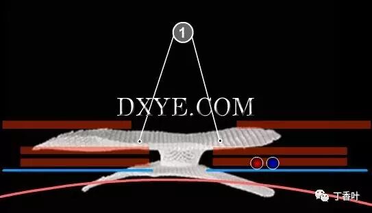 疝气补片怎么固定双层补片修补腹股沟疝（图文演示）_https://www.jmylbn.com_新闻资讯_第70张