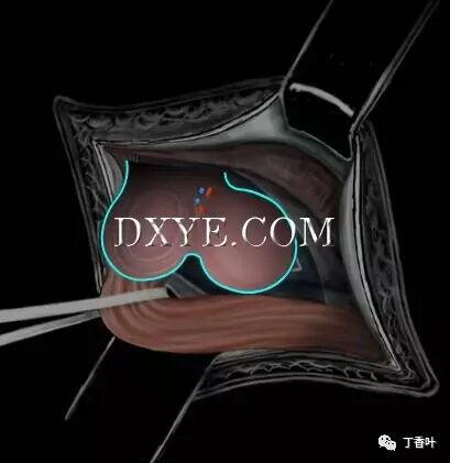 疝气补片怎么固定双层补片修补腹股沟疝（图文演示）_https://www.jmylbn.com_新闻资讯_第40张