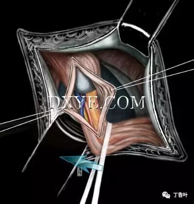疝气补片怎么固定双层补片修补腹股沟疝（图文演示）_https://www.jmylbn.com_新闻资讯_第35张