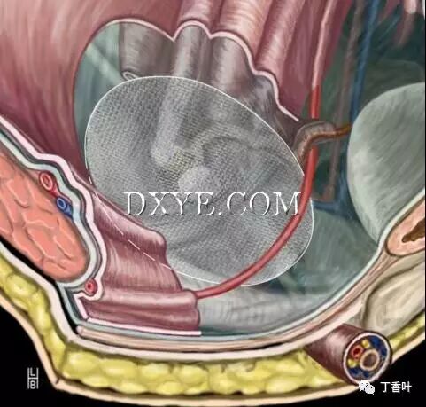 疝气补片怎么固定双层补片修补腹股沟疝（图文演示）_https://www.jmylbn.com_新闻资讯_第53张