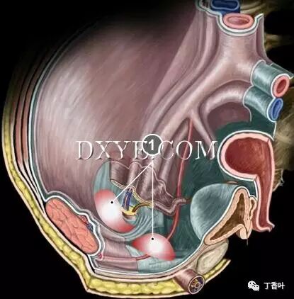 疝气补片怎么固定双层补片修补腹股沟疝（图文演示）_https://www.jmylbn.com_新闻资讯_第12张