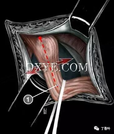 疝气补片怎么固定双层补片修补腹股沟疝（图文演示）_https://www.jmylbn.com_新闻资讯_第33张