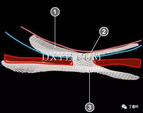 疝气补片怎么固定双层补片修补腹股沟疝（图文演示）_https://www.jmylbn.com_新闻资讯_第59张