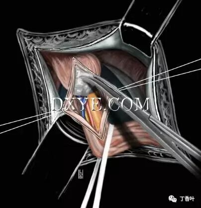 疝气补片怎么固定双层补片修补腹股沟疝（图文演示）_https://www.jmylbn.com_新闻资讯_第43张