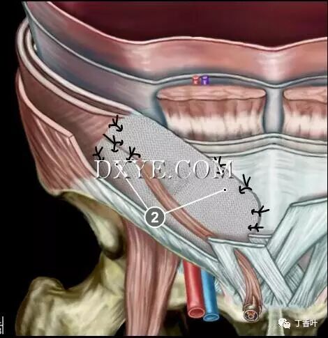 疝气补片怎么固定双层补片修补腹股沟疝（图文演示）_https://www.jmylbn.com_新闻资讯_第57张