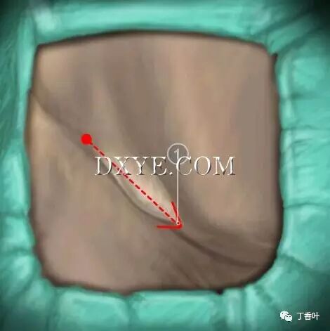 疝气补片怎么固定双层补片修补腹股沟疝（图文演示）_https://www.jmylbn.com_新闻资讯_第24张
