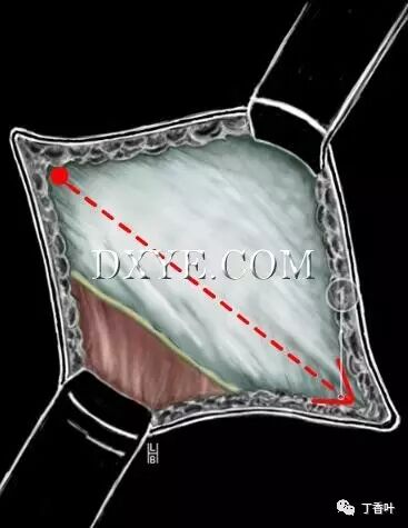 疝气补片怎么固定双层补片修补腹股沟疝（图文演示）_https://www.jmylbn.com_新闻资讯_第26张