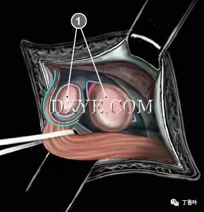 疝气补片怎么固定双层补片修补腹股沟疝（图文演示）_https://www.jmylbn.com_新闻资讯_第38张