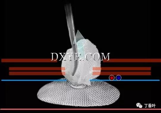 疝气补片怎么固定双层补片修补腹股沟疝（图文演示）_https://www.jmylbn.com_新闻资讯_第66张