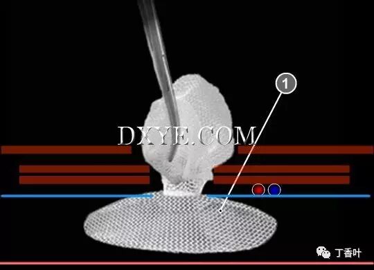 疝气补片怎么固定双层补片修补腹股沟疝（图文演示）_https://www.jmylbn.com_新闻资讯_第69张