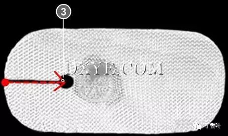 疝气补片怎么固定双层补片修补腹股沟疝（图文演示）_https://www.jmylbn.com_新闻资讯_第73张